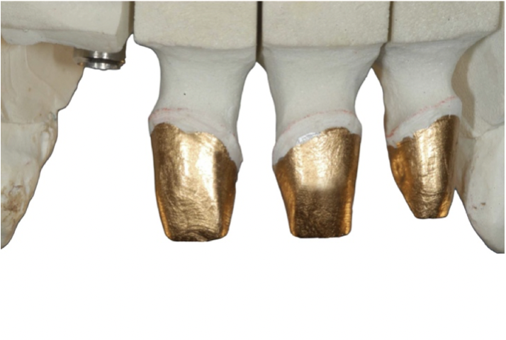 La foto raffigura il modello con denti preparati e analogo dell'impianto